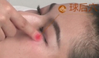 球后穴清热明目 缓解近视、斜视